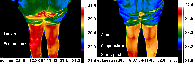 infrared image
                            before & after acupuncture